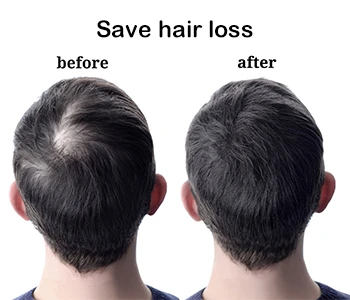 Ua Bald--yuav ua rau yau, Thiab Androgenic Alopecia yog qhov ntau tshaj